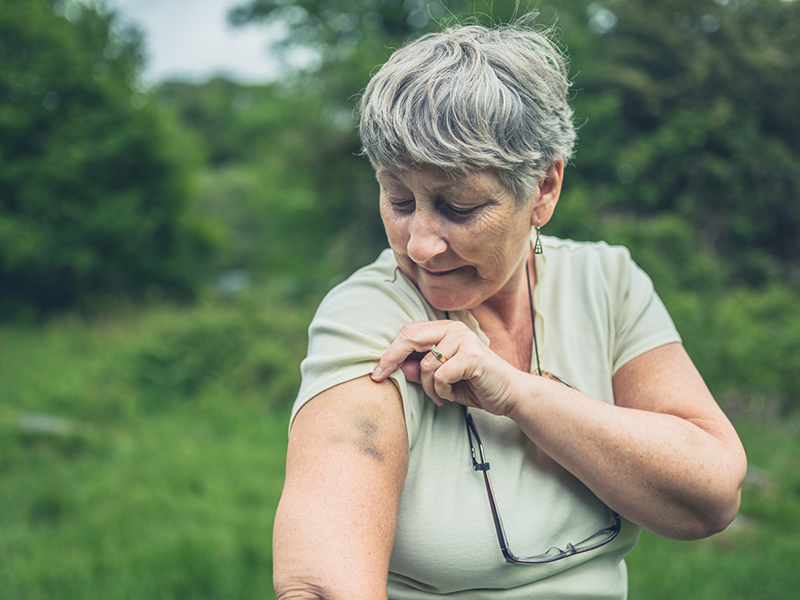 senior lady looking at arm bruise